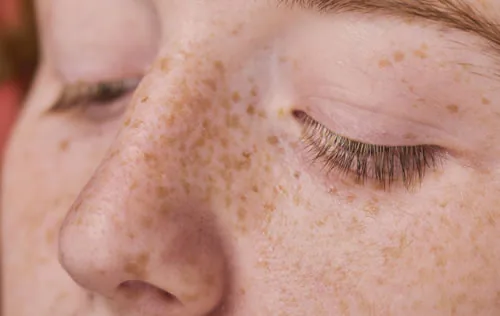 shoulder with freckles<br />
