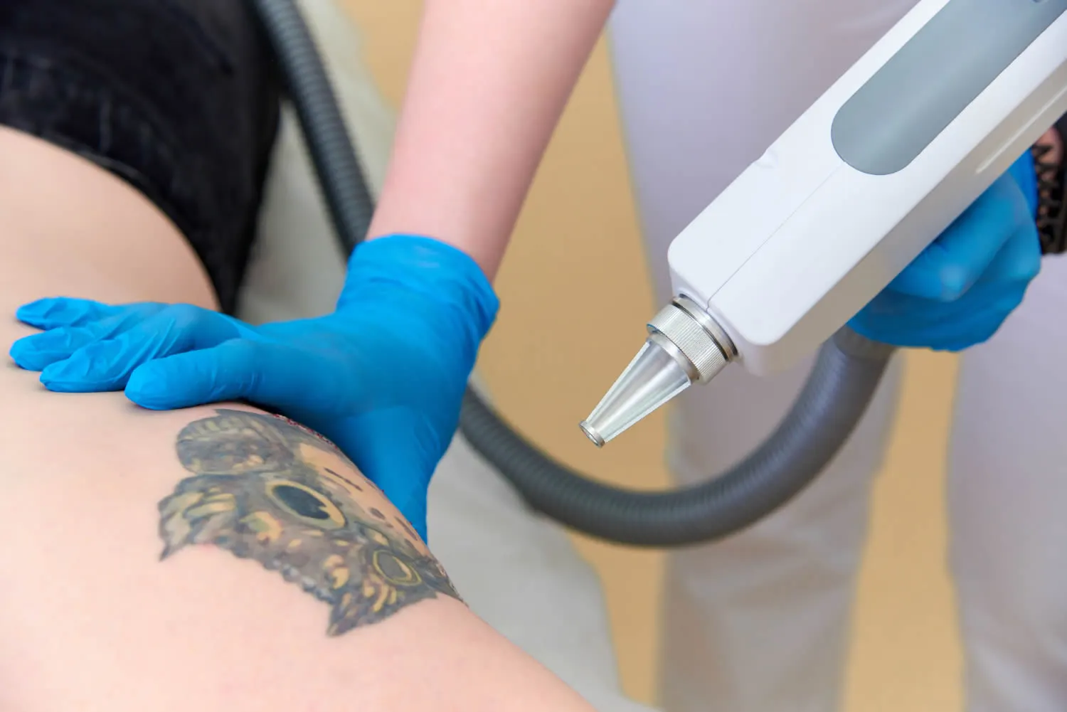 medical dermatology woman procedure-removal-tattoo-laser-cosmetic-dermatology