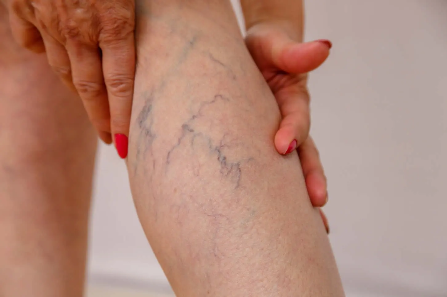 medical dermatology woman spider veins on legs