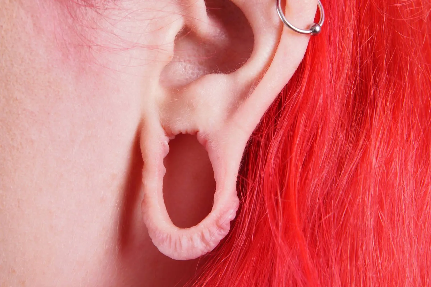 medical dermatology woman stretched-ear-lobe-repair-dermatologist