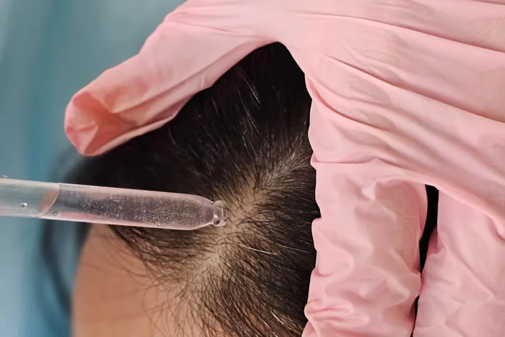 dermatologist-treating-lice