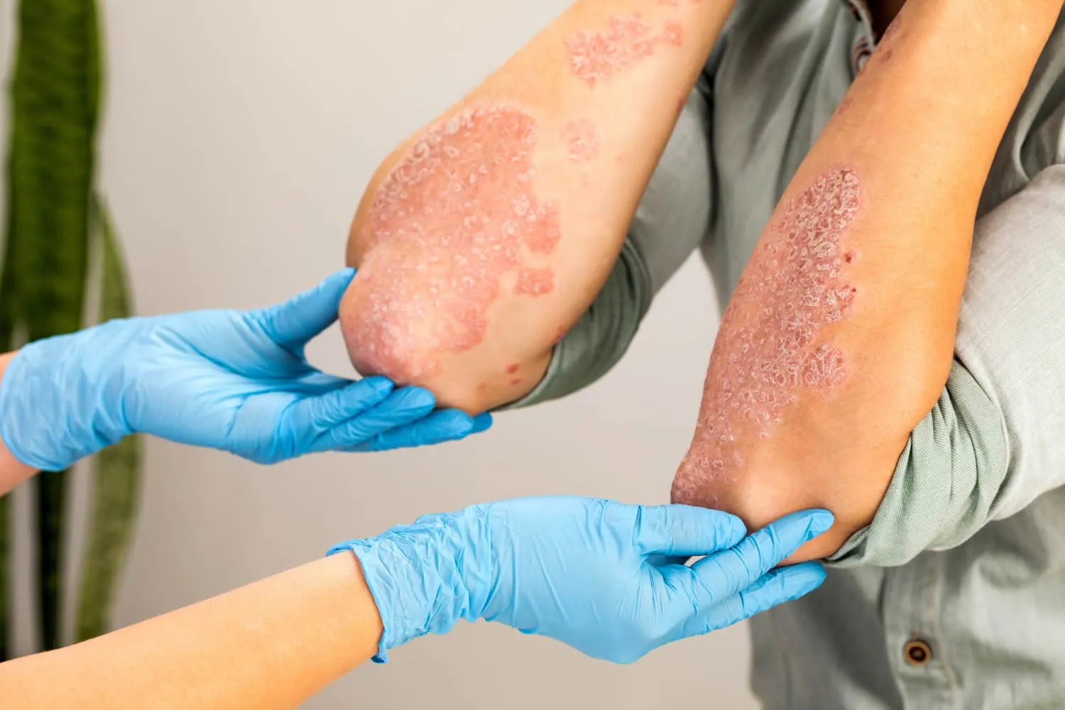medical dermatology woman dermatologist-wearing-gloves-examines-skin-sick-eczema-dermatitis