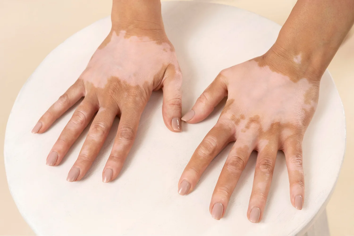 medical dermatology woman woman-with-vitiligo