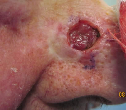 skin cancer after MOHS surgery on side of nose open wound